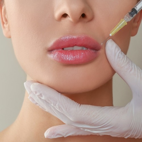 preenchimento-com-ácido-hialuronico-em-guarulhos-uemura-estetica-estetica-em-guarulhos