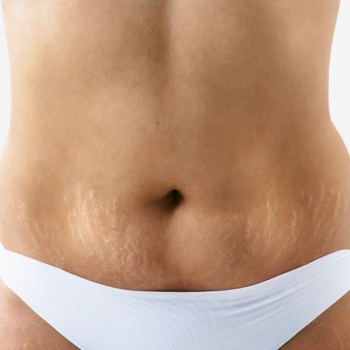 tratamento-para-estrias-em-guarulhos-uemura-estetica-guarulhos-estrias-gordura-localizada