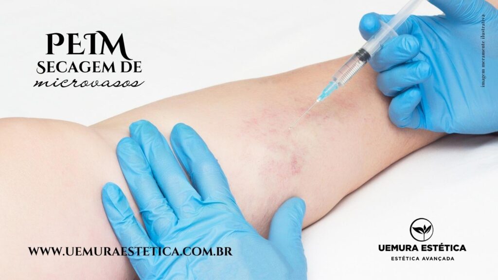 Secagem de vasinhos em Guarulhos - Uemura Estética em Guarulhos  PEIM