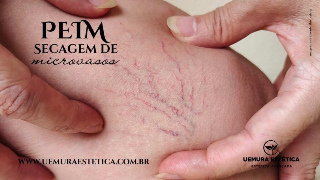 Secagem de Microvasos em Guarulhos varizes Estética em Guarulhos Uemura Estética