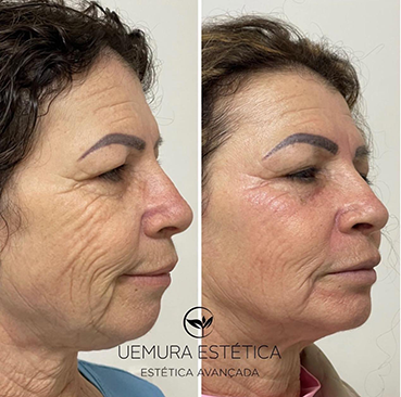 peeling em Guarulhos peeling ATA peeling quimico guarulhos estética