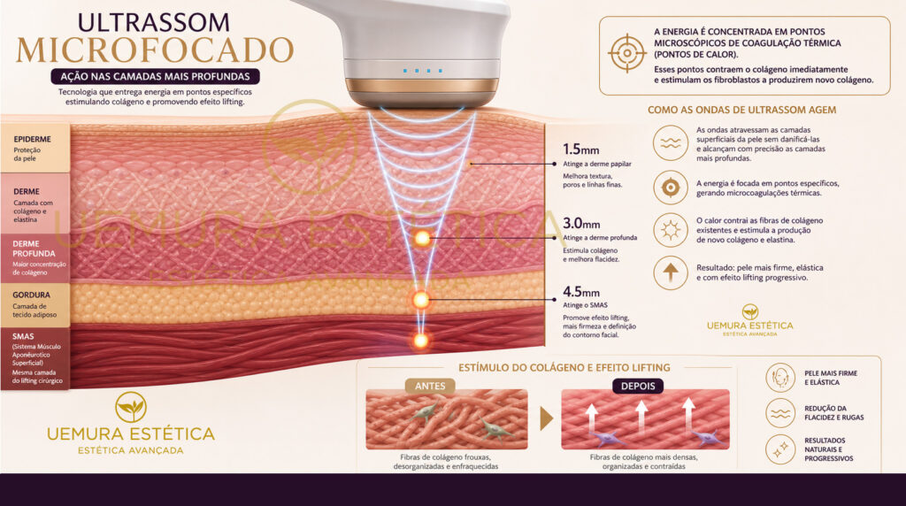 ultrassom microfocado em Guarulhos com HIPRO atuando nas camadas profundas da pele estimulando colágeno